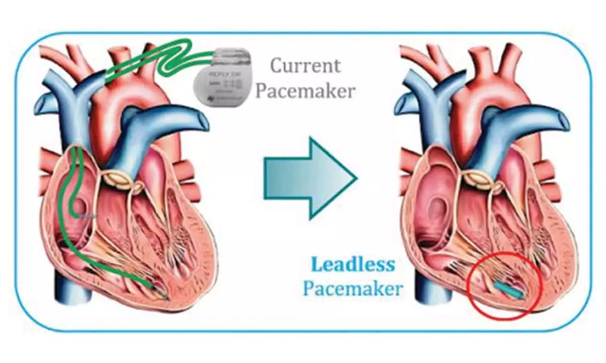 Leadless Pacemaker Design A leadless pacemaker that precisely stimulates multiple areas of the ...