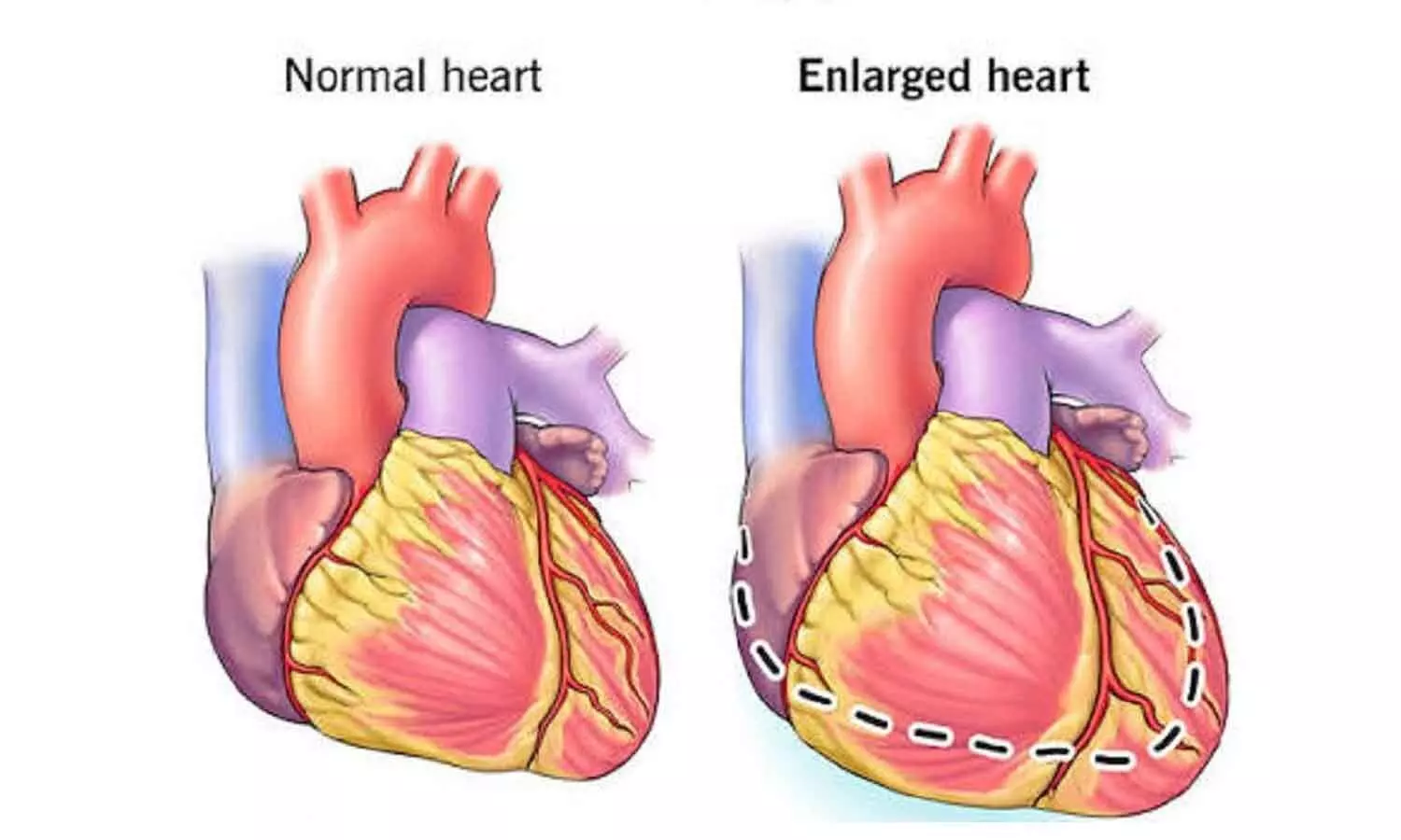 Steady stress, chronic inflammation can change heart structure Steady stress, chronic inflammation can change heart structure